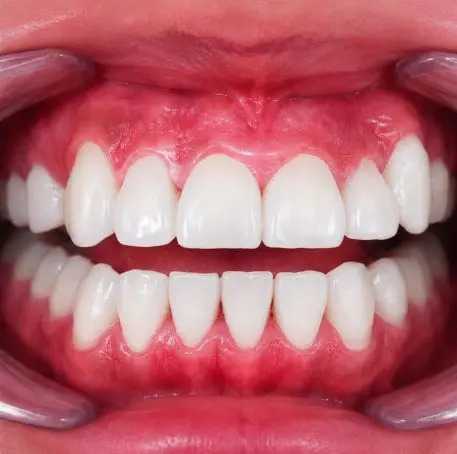 Sonrisa después del blanqueamiento